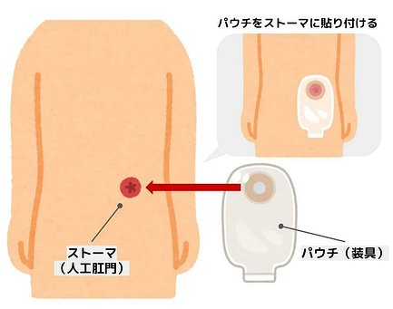 ストーマとは｜パウチ（装具）の種類、ケアの方法、介護方法などを紹介 
